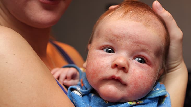 Common Childhood Illnesses: Eczema